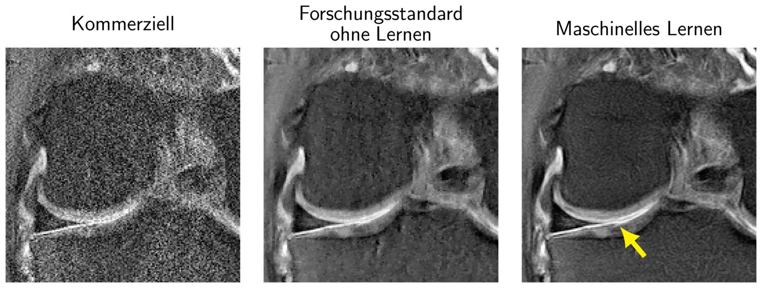 MRT Rekonstruktion mit Deep Learning
© Kerstin Hammernik